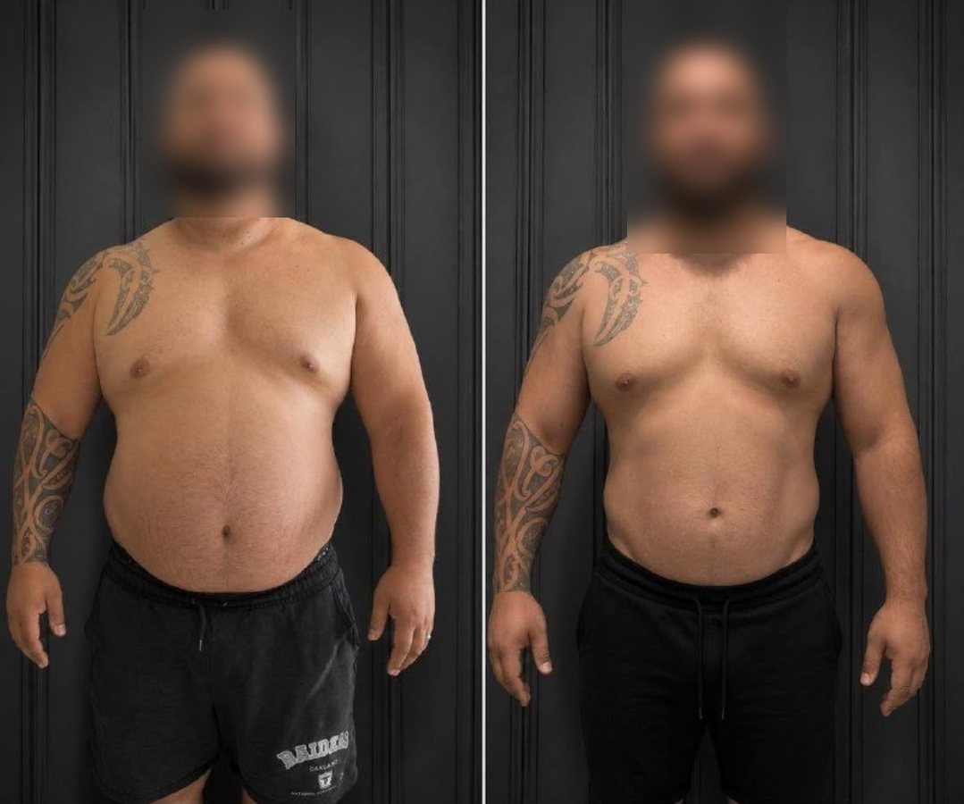 Before and after: torso, front view