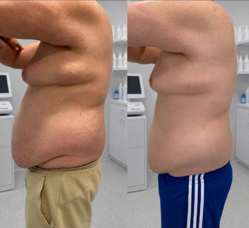 Before and after: abdomen, side view